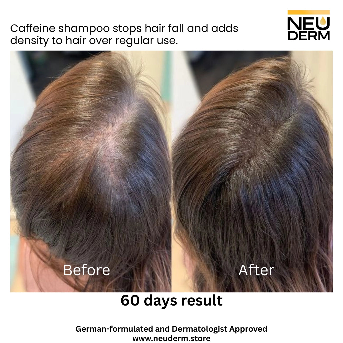 NeuDerm™ Caffeine Anti Hair Loss Shampoo