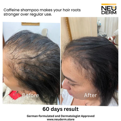 NeuDerm™ Caffeine Anti Hair Loss Shampoo